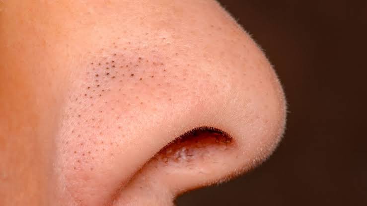 Mudah dan Efektif, 9 Cara Hilangkan Pori-Pori Hitam di Hidung Agar Tampil Lebih Percaya Diri