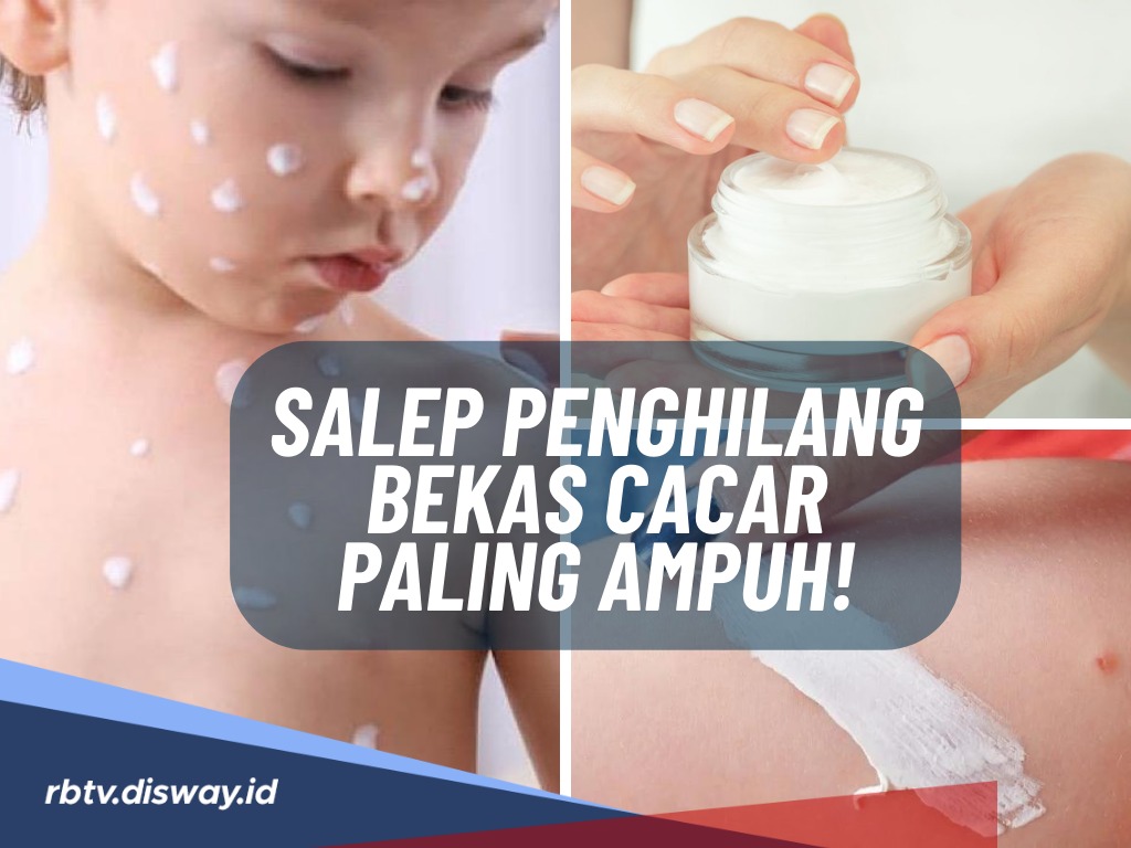 10 Salep untuk Menghilangkan Bekas Cacar Air Ampuh, Terbaik Rekomendasi Dokter