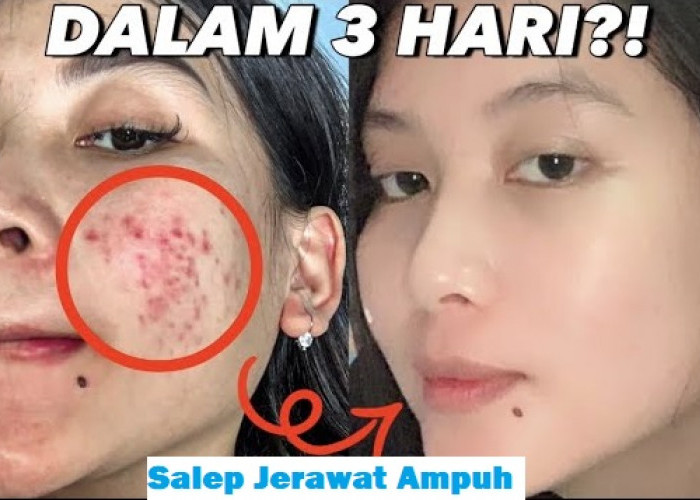 Selain Skincare, 8 Masker Jerawat di Apotik Ini Ampuh Bersihkan Jerawat