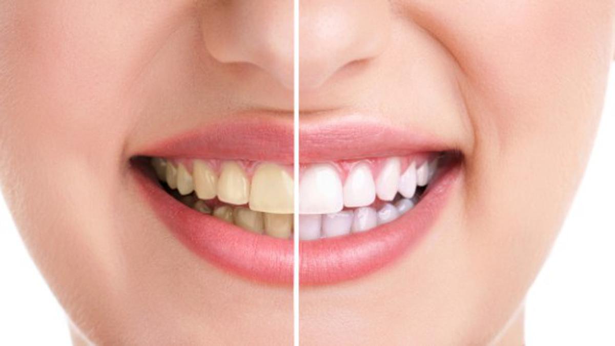 Ternyata 4 Kebiasaan ini Dapat Membuat Gigi Anda Menguning, Simak Juga Cara Mencerahkannya