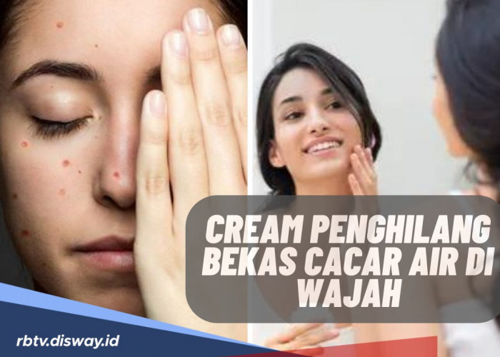 Khawatir Bisa Meninggalkan Bekas, Ini Cream Penghilang Bekas Cacar Air di Wajah