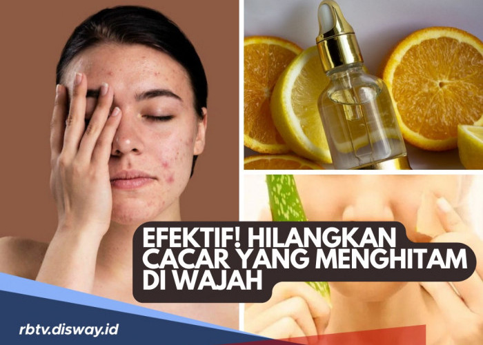 Jangan Sampai Tidak Percaya Diri, Ini 5 Cara Menghilangkan Bekas Cacar Air yang Menghitam di Wajah