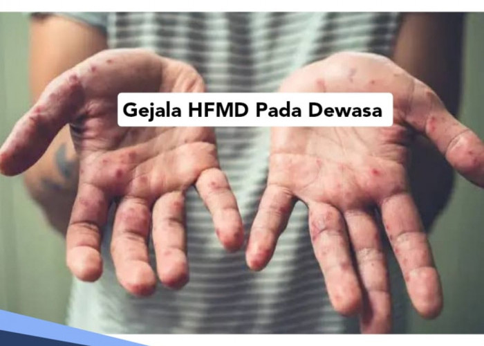 Ada Ruam di Tangan? Hati-hati, Kenali Gejala HFMD atau Flu Singapura pada Orang Dewasa 